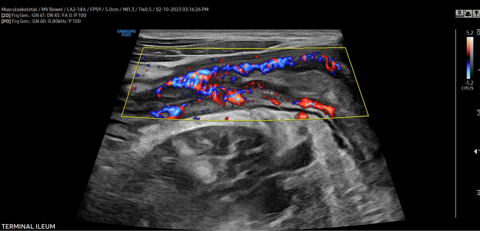 Safe & Accurate Intestinal Ultrasound