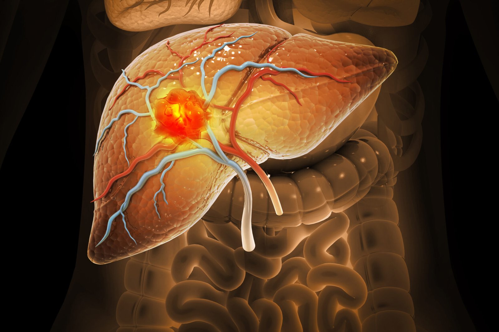 Liver Cancer Treatment in Mumbai