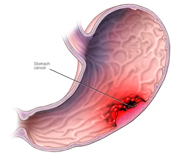Best Stomach Cancer Treatment in Mumbai