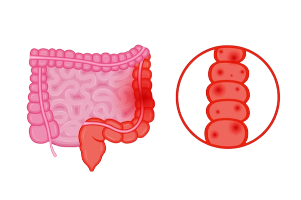 Ulcerative Colitis