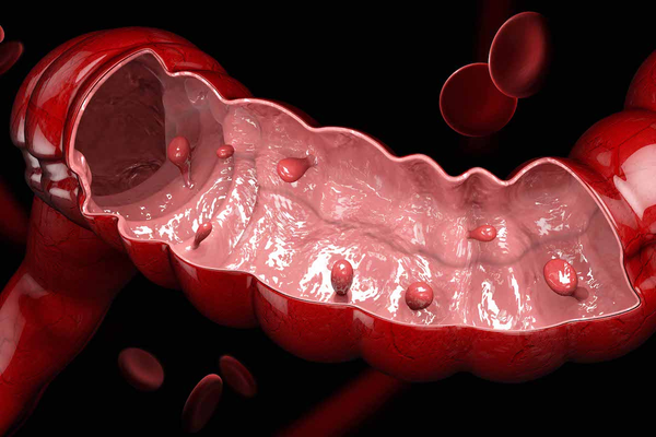 Colorectal Polis
