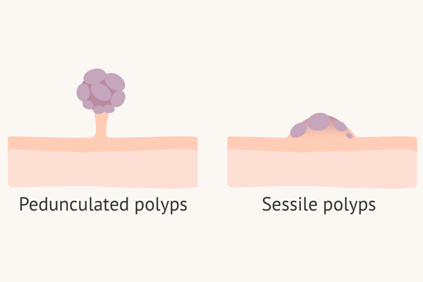 Polypectomy Surgery in Mumbai