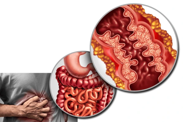 Safe & Accurate Intestinal Ultrasound