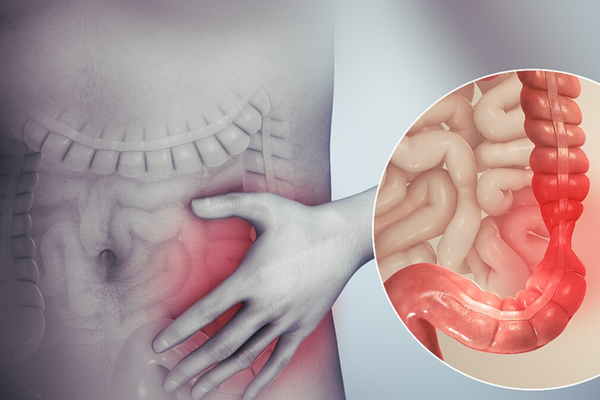 ibs