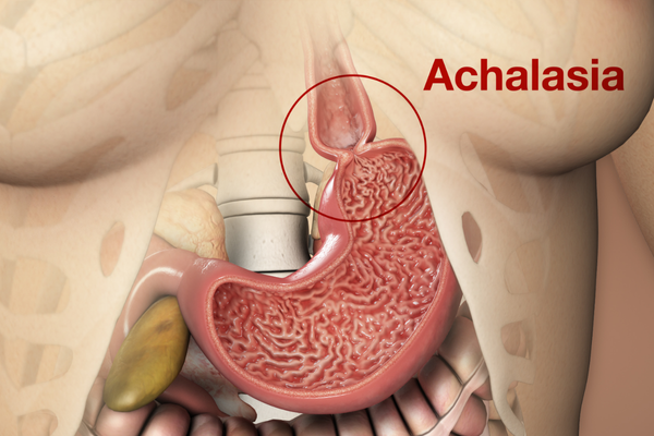 Achalasia