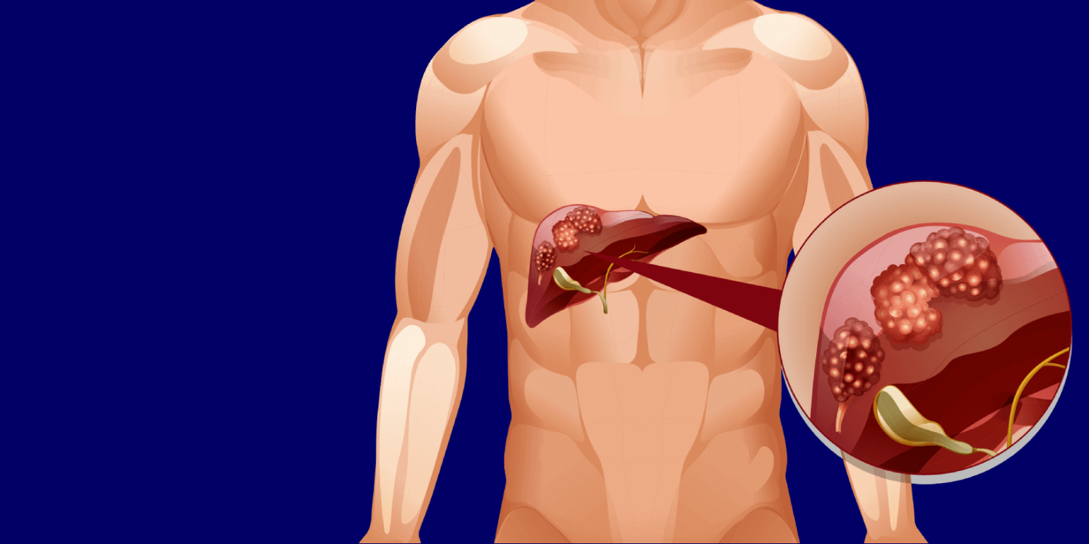 Liver Cancer Treatment in Mumbai