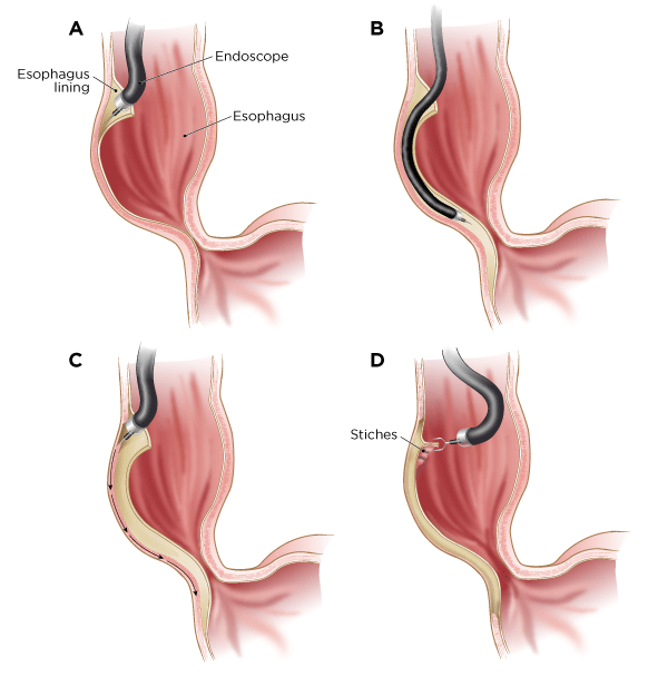 Peroral Endoscopic Myotomy (POEM) Procedure in Mumbai