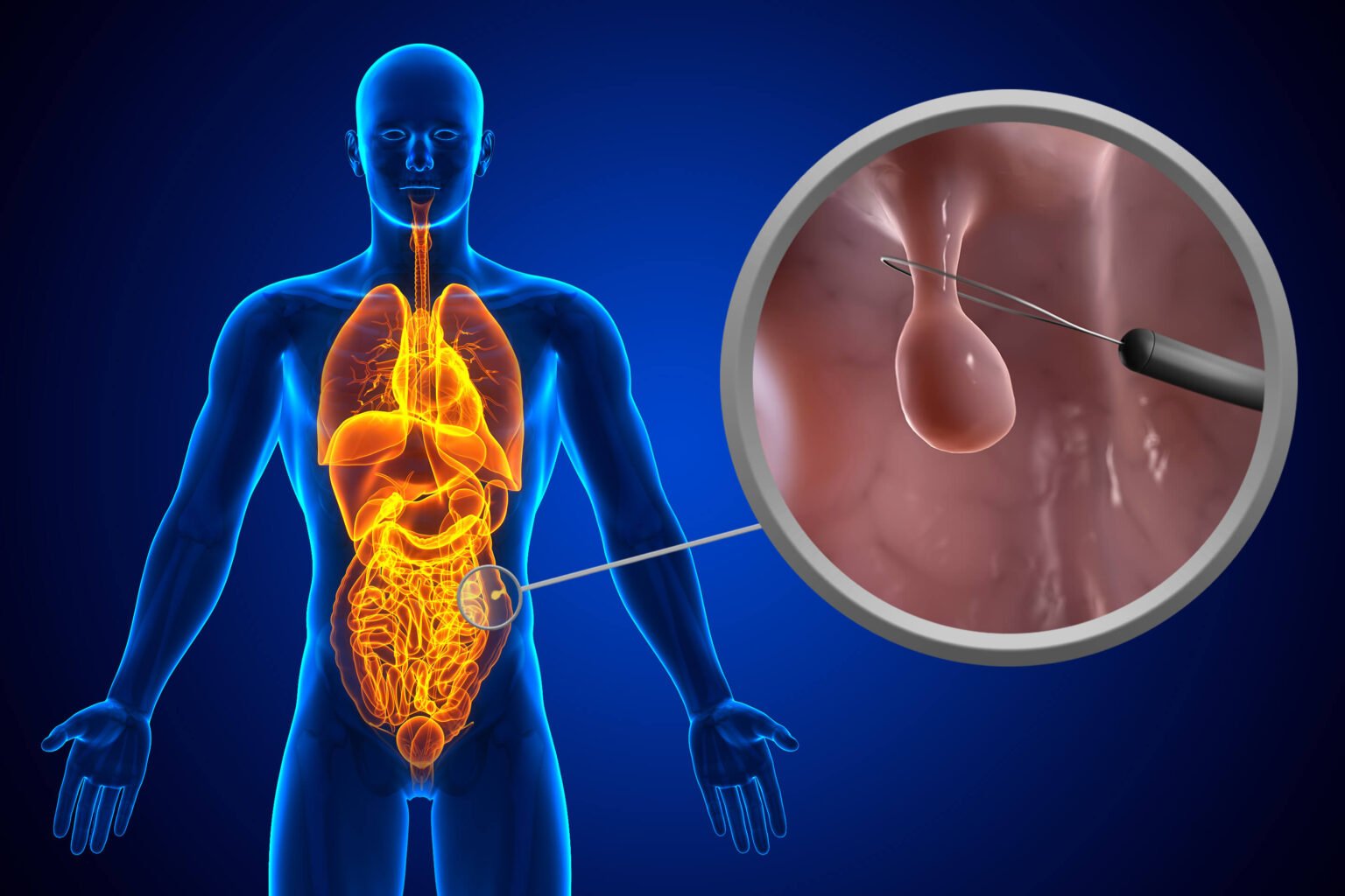 Polypectomy Surgery in Mumbai