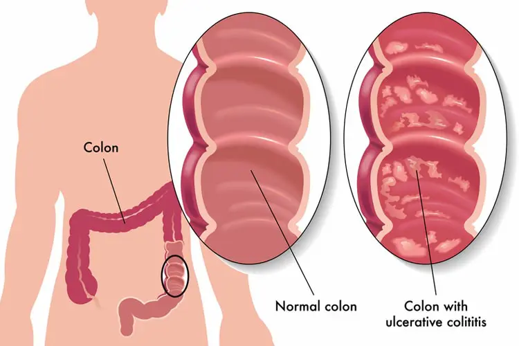 Ulcerative Colitis Treatment in Mumbai