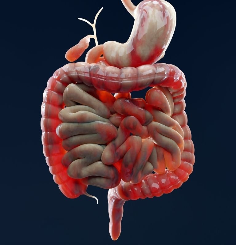 Crohn's Disease