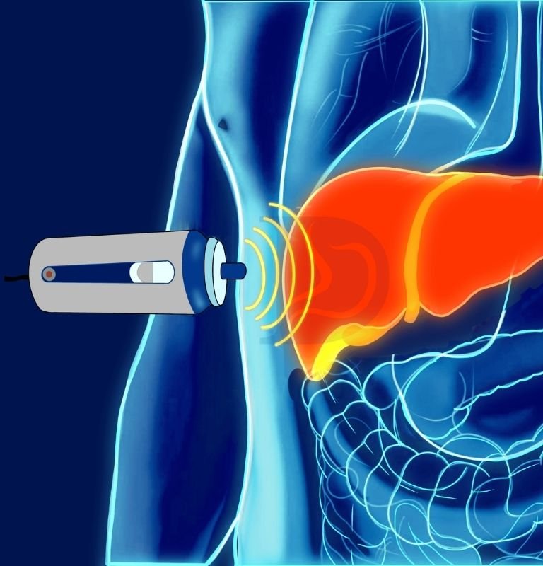 Fibroscan