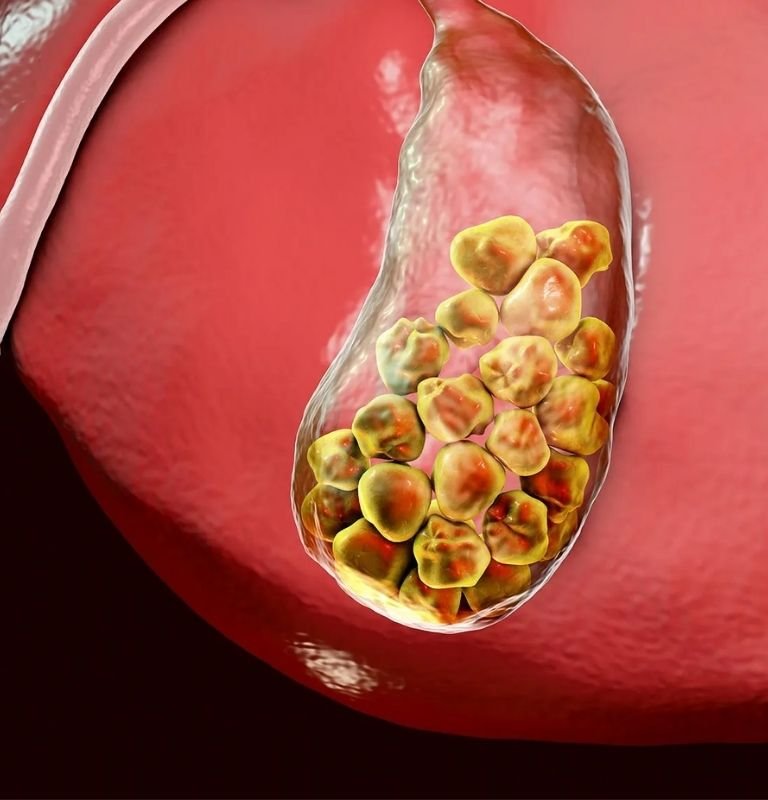 Gall Stones