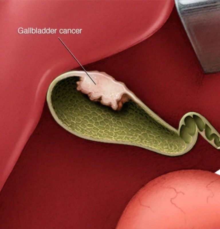 Gall bladder cancer