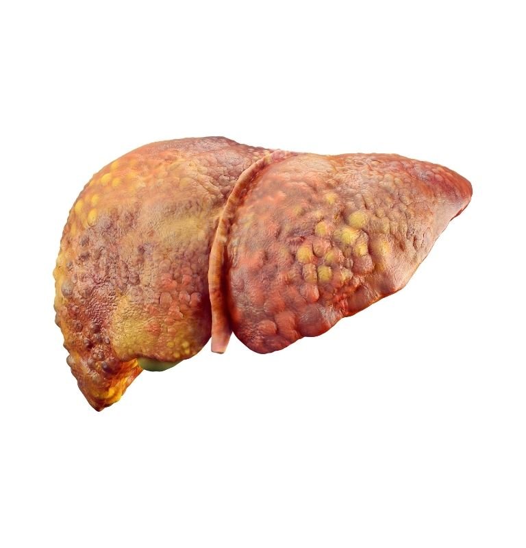 Liver Cirrhosis