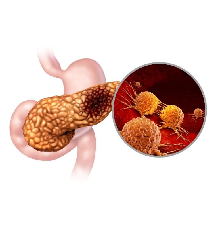 Pancreatic cancer