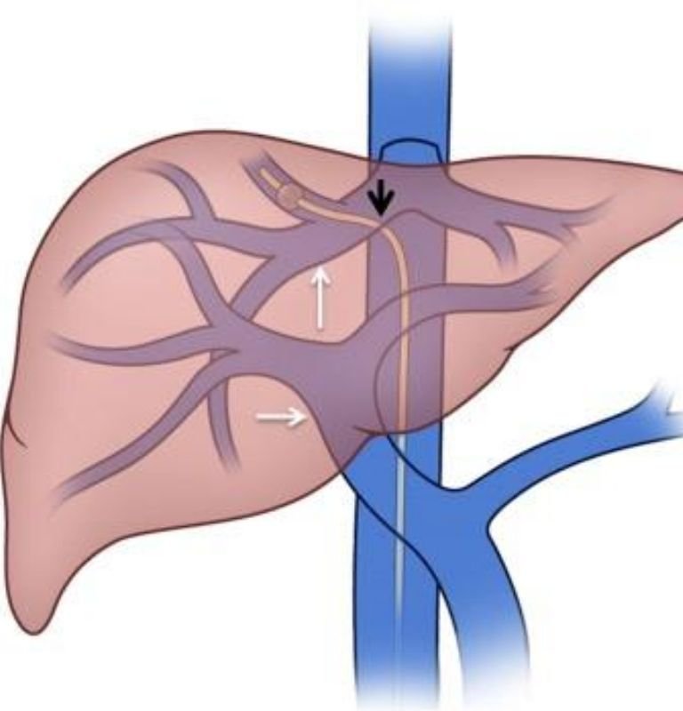Portal hypertension Management