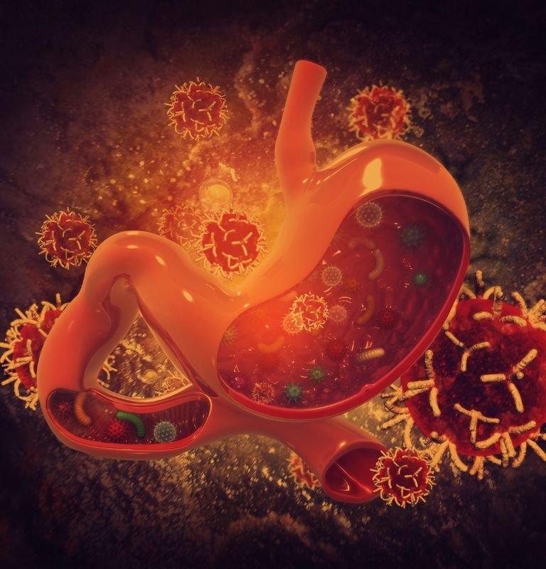 Stomach Cancer
