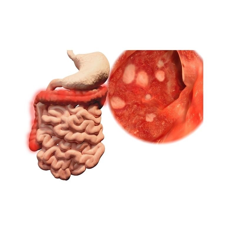 Ulcerative colits