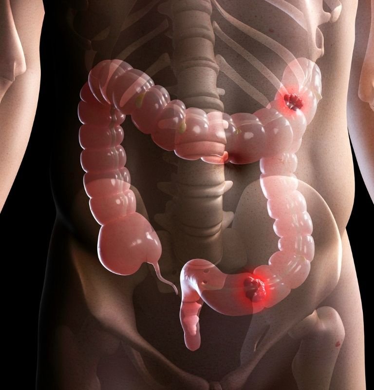 Colon Cancer