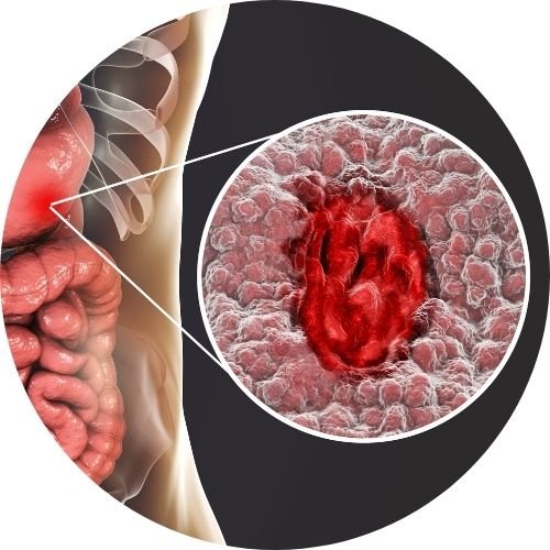 Gastritics and Ulcers