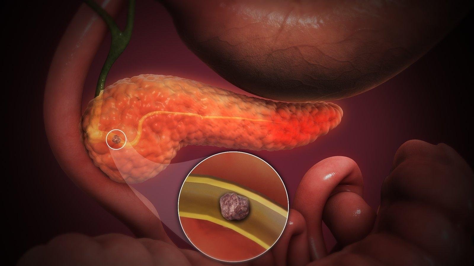 Best treatment for pancreatitis in Mumbai