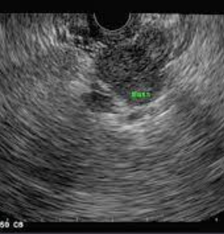 endoscopic ultrasound